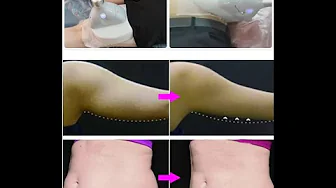 Freezing fat cells: claims to remove fat without surgery